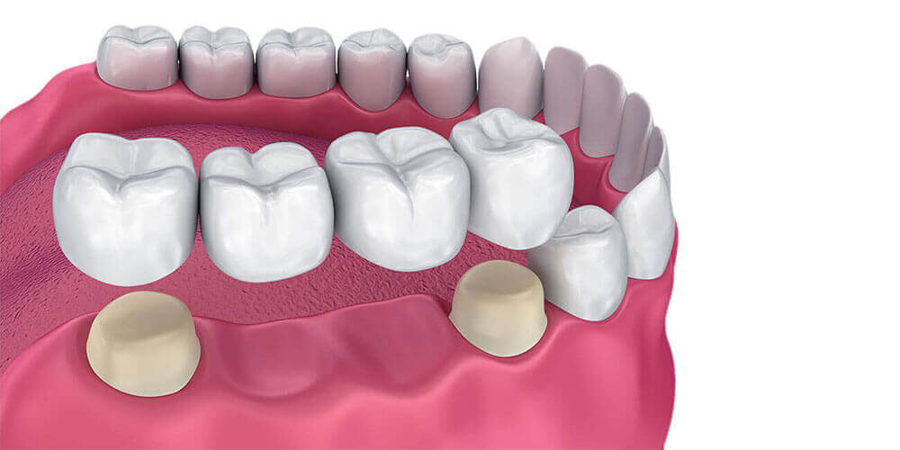Dental Bridges Chestermere