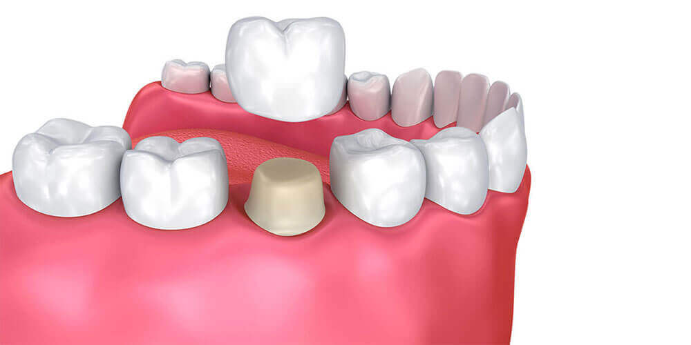 Dental Crowns Chestermere
