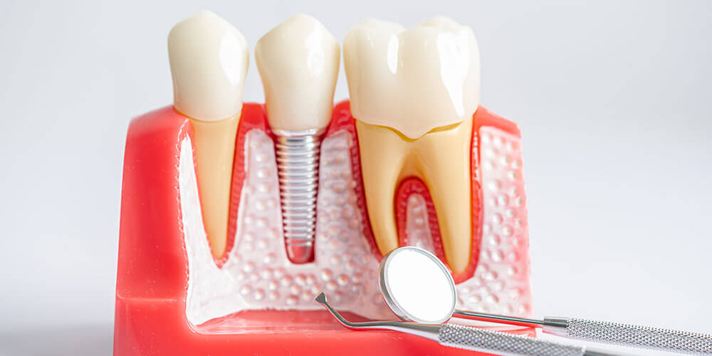 Dental Implants Chestermere