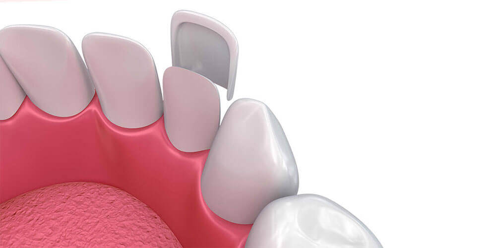 Custom dental veneers in Chestermere