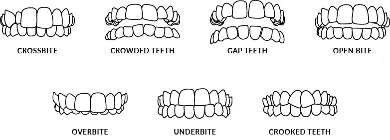 Examples of teeth alignment issues Invisalign can treat